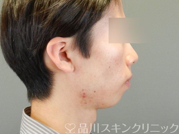 症例NO.65027のAFTER写真