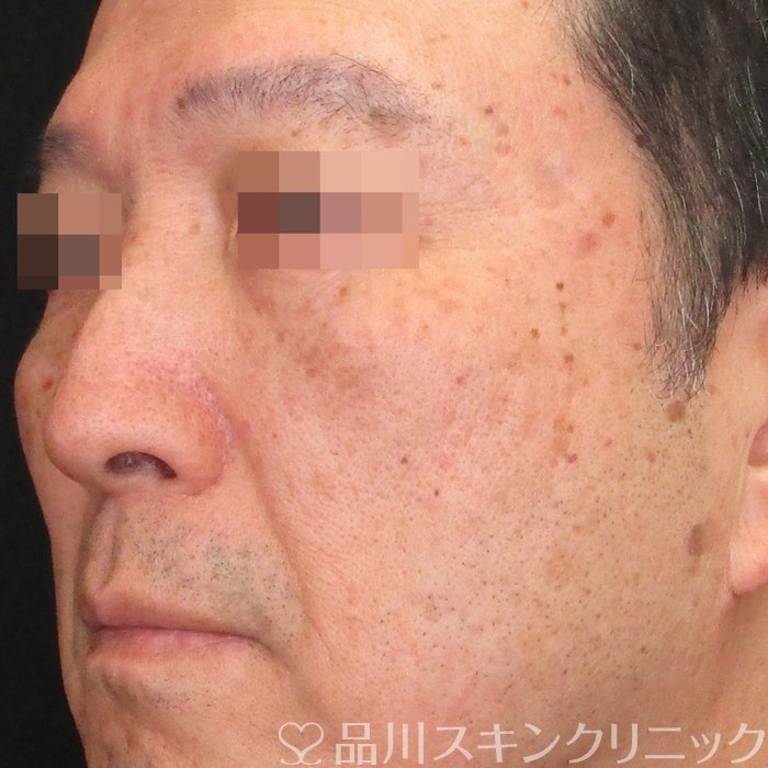 症例NO.73819のAFTER写真
