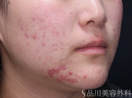 症例NO.72230のBEFORE写真