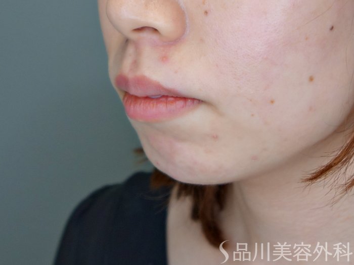 症例NO.70927のBEFORE写真