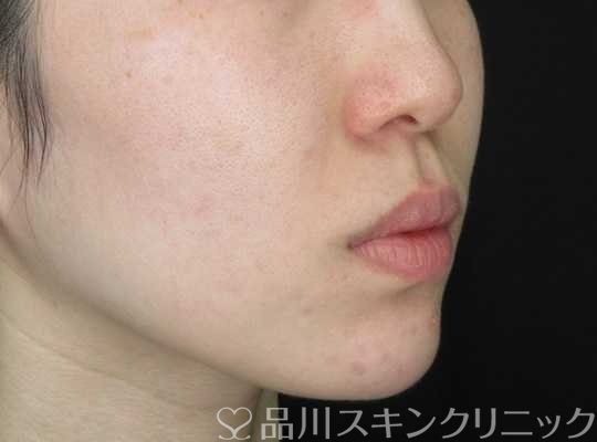 症例NO.67630のAFTER写真