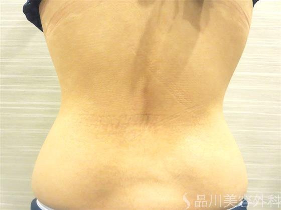 症例NO.24039のAFTER写真