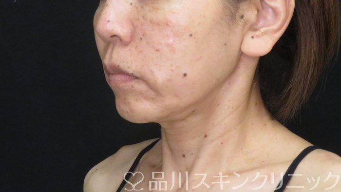 症例NO.72148のBEFORE写真