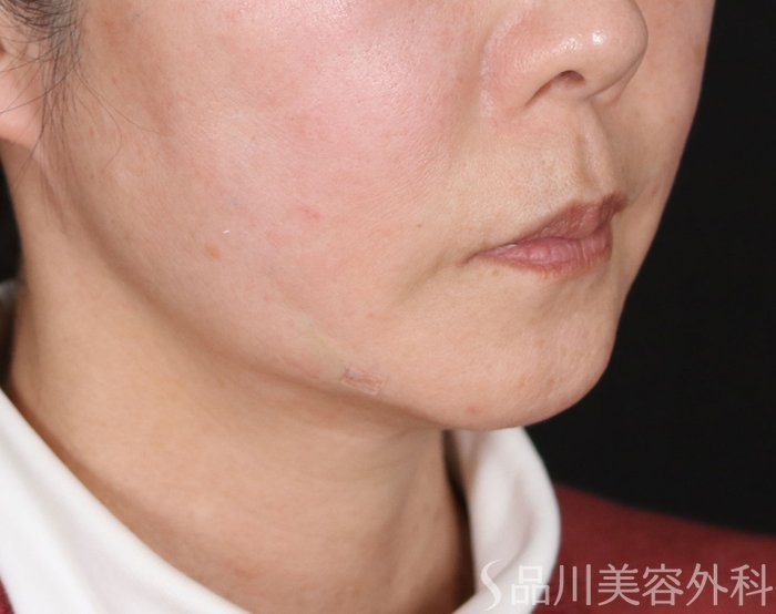 症例NO.72173のAFTER写真