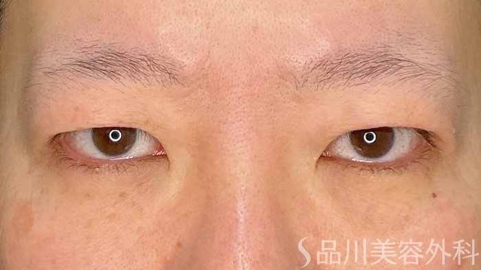 症例NO.72999のBEFORE写真