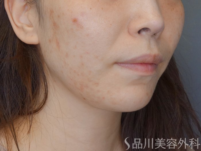 症例NO.71399のBEFORE写真