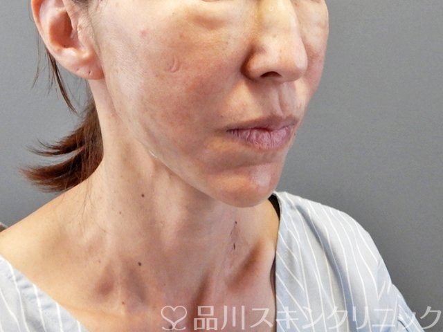症例NO.66253のAFTER写真