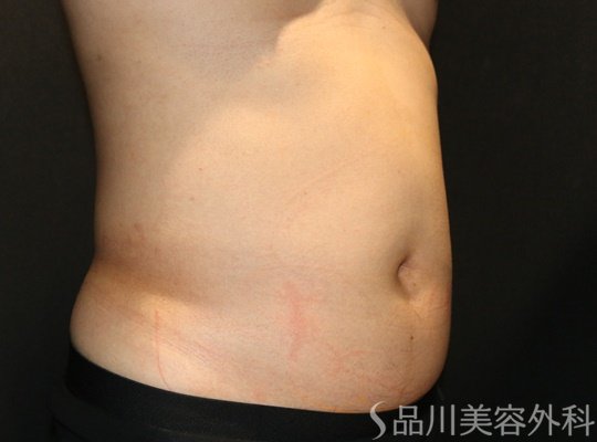症例NO.71025のBEFORE写真