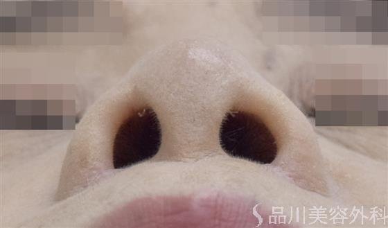 症例NO.48901のAFTER写真