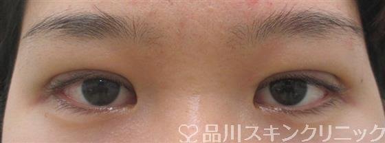症例NO.27864のAFTER写真