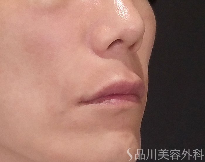 症例NO.70497のAFTER写真