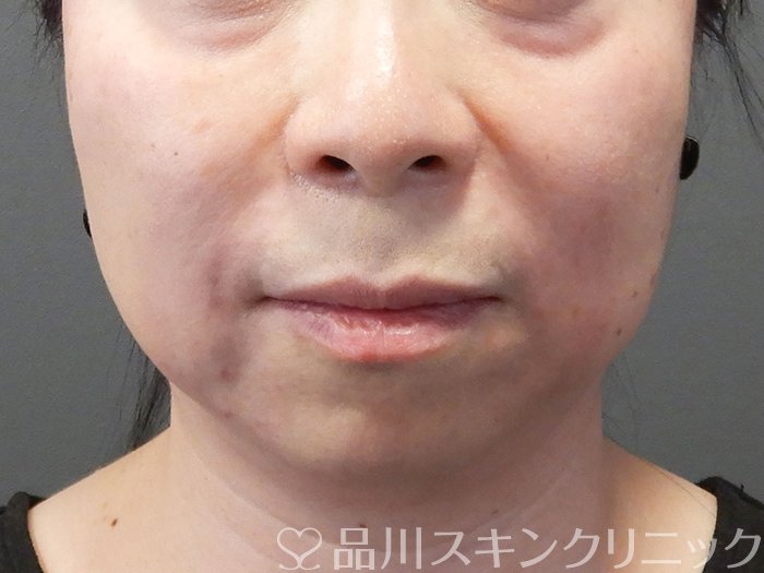 症例NO.72990のAFTER写真