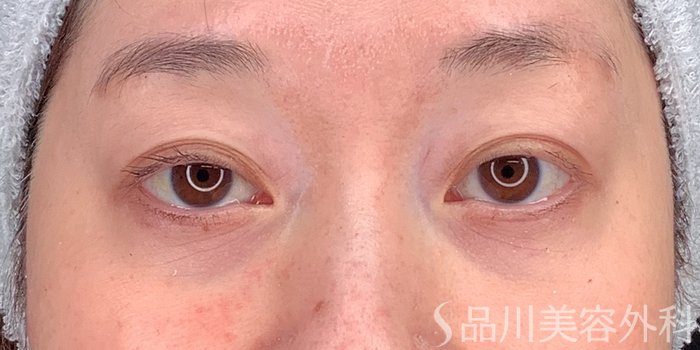 症例NO.71225のBEFORE写真