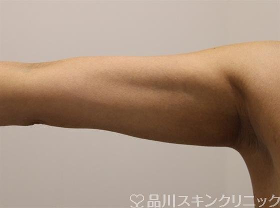 症例NO.49239のBEFORE写真