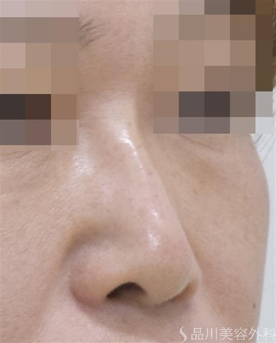 症例NO.50010のAFTER写真