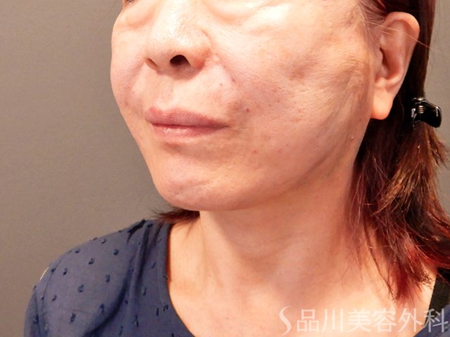 症例NO.71190のAFTER写真