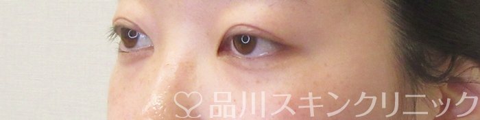 症例NO.74203のAFTER写真