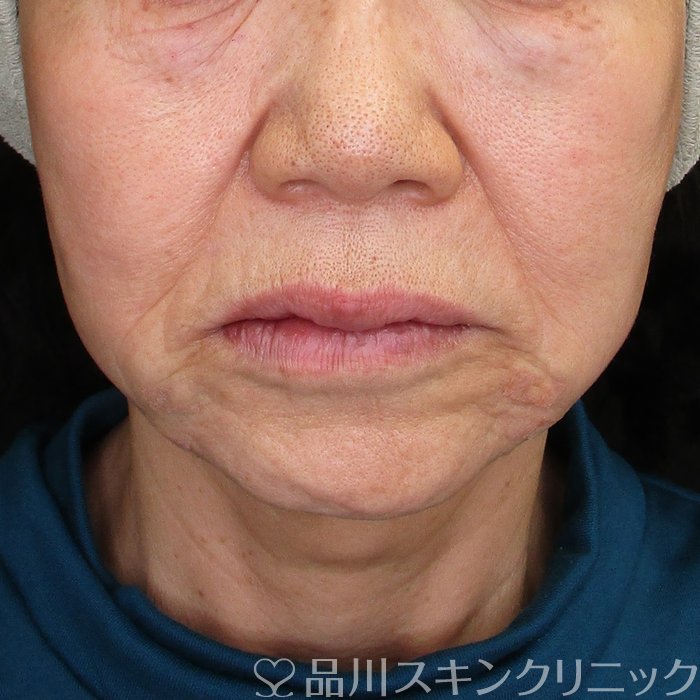 症例NO.73673のAFTER写真