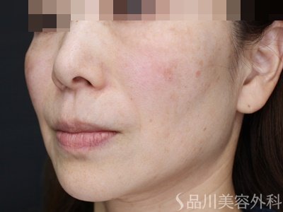 症例NO.70993のAFTER写真