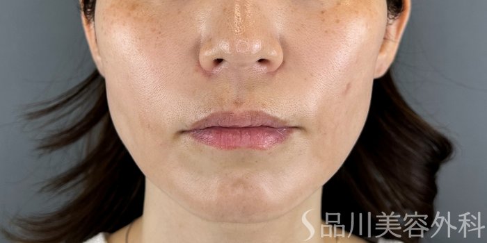 症例NO.70175のAFTER写真