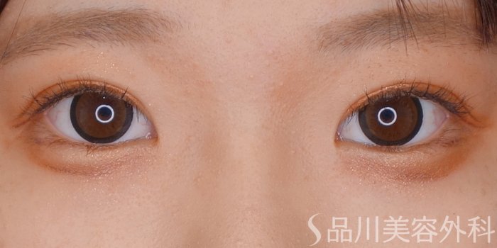 症例NO.70131のAFTER写真