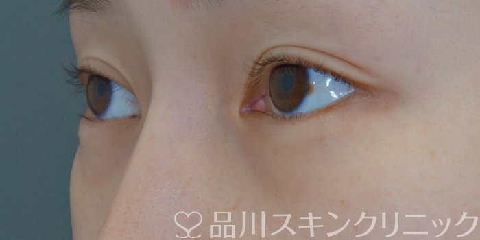 症例NO.72481のBEFORE写真