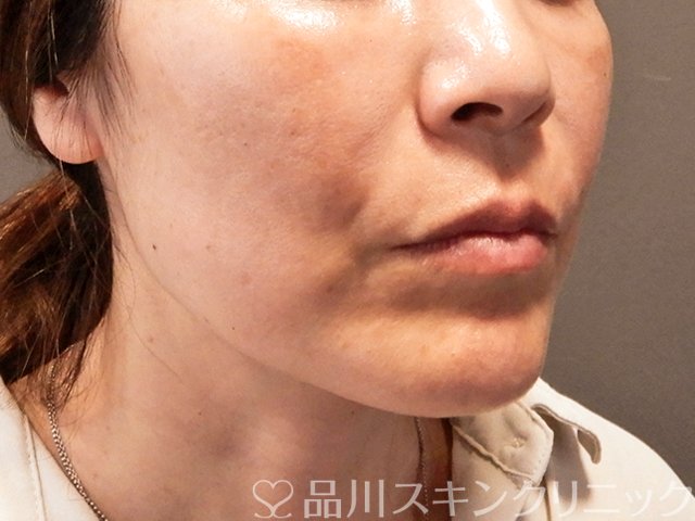 症例NO.70824のAFTER写真