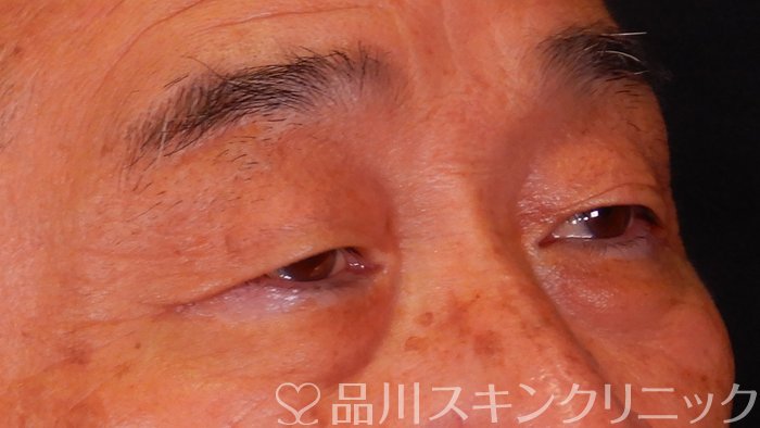 症例NO.65677のBEFORE写真