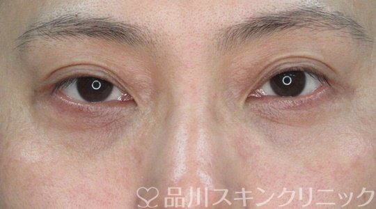 症例NO.71113のAFTER写真