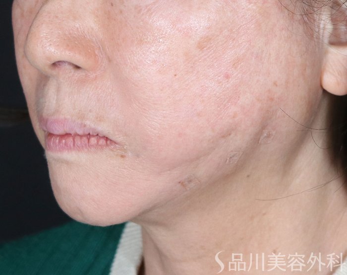 症例NO.72742のAFTER写真