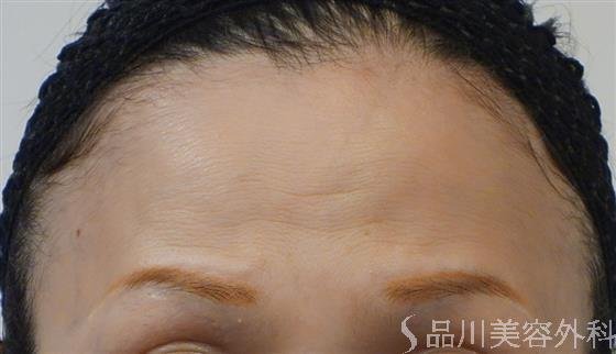 症例NO.51172のBEFORE写真