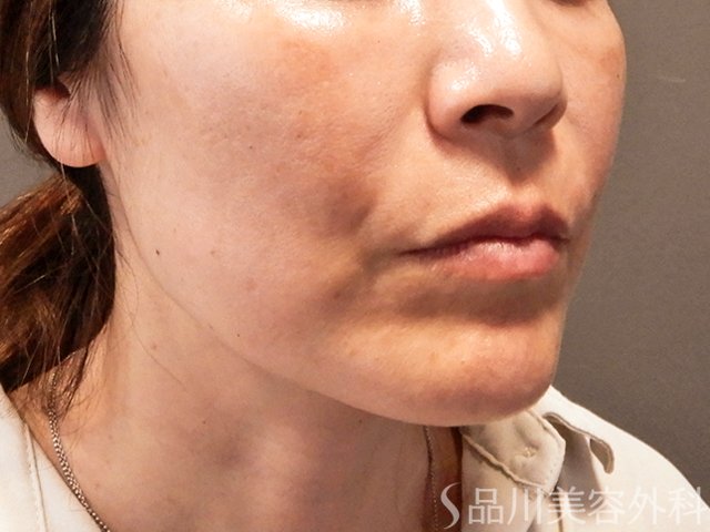 症例NO.70824のAFTER写真