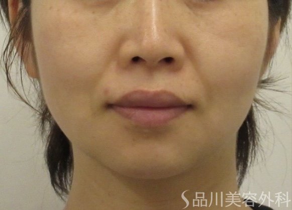 症例NO.74074のBEFORE写真