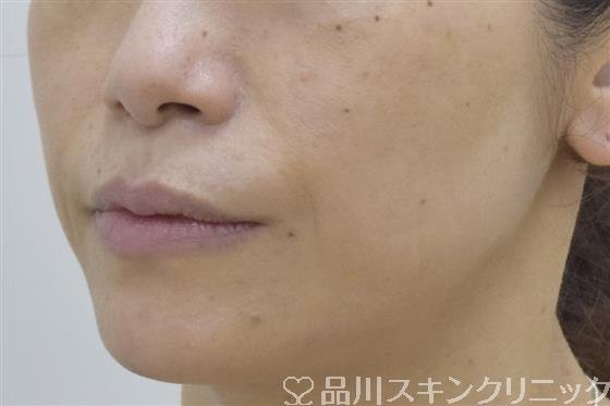 症例NO.53406のBEFORE写真