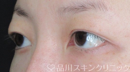 症例NO.68366のBEFORE写真