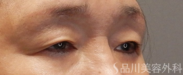 症例NO.71383のBEFORE写真