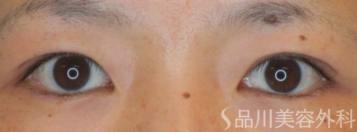 症例NO.64746のAFTER写真