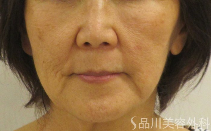 症例NO.65050のBEFORE写真