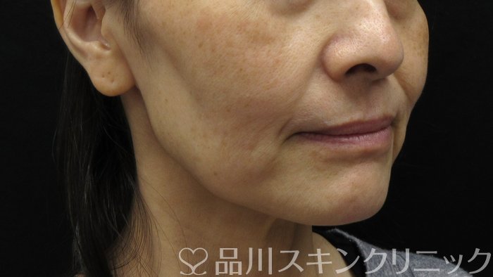症例NO.71434のBEFORE写真