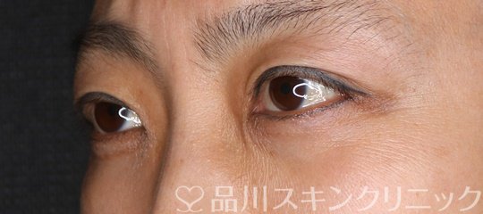 症例NO.74951のAFTER写真