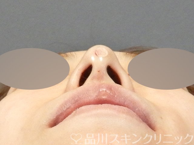 症例NO.64935のAFTER写真
