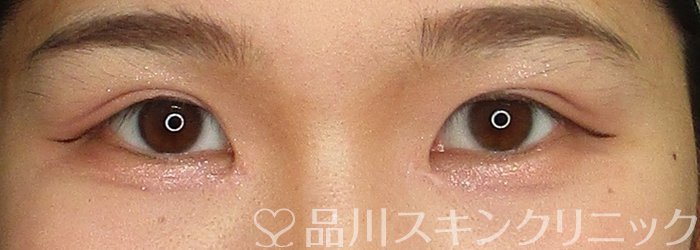 症例NO.69962のAFTER写真