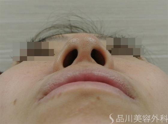 症例NO.16426のBEFORE写真