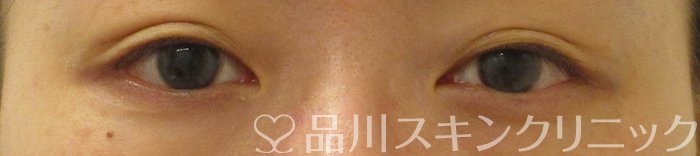 症例NO.65338のBEFORE写真