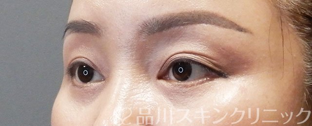 症例NO.73276のAFTER写真