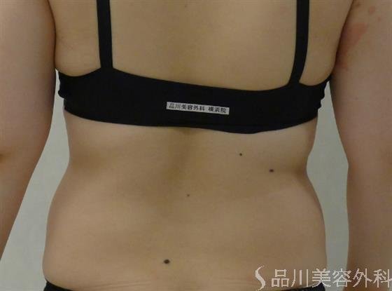 症例NO.35186のAFTER写真