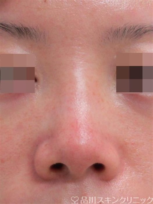 症例NO.29911のBEFORE写真