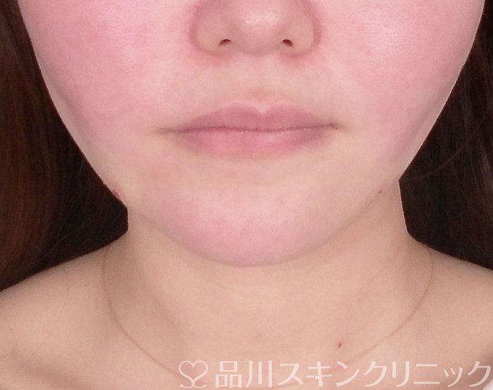 症例NO.69771のAFTER写真
