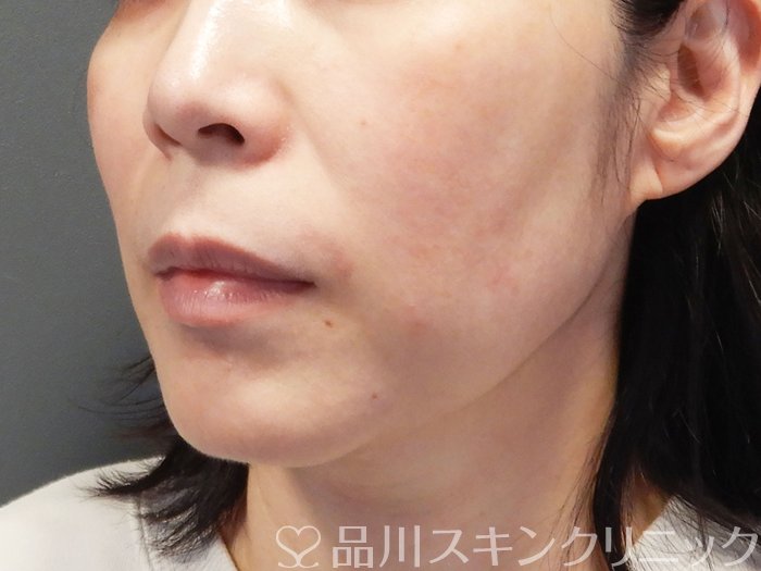 症例NO.74687のBEFORE写真