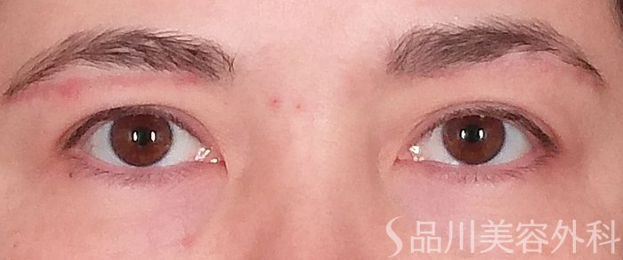 症例NO.69352のAFTER写真